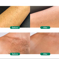Before and after comparison of hair removal effect on skin